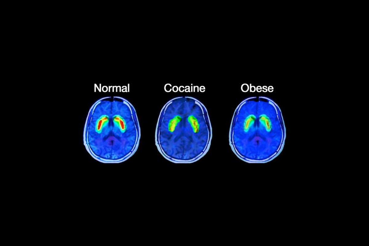Sugar Effect on Brain
